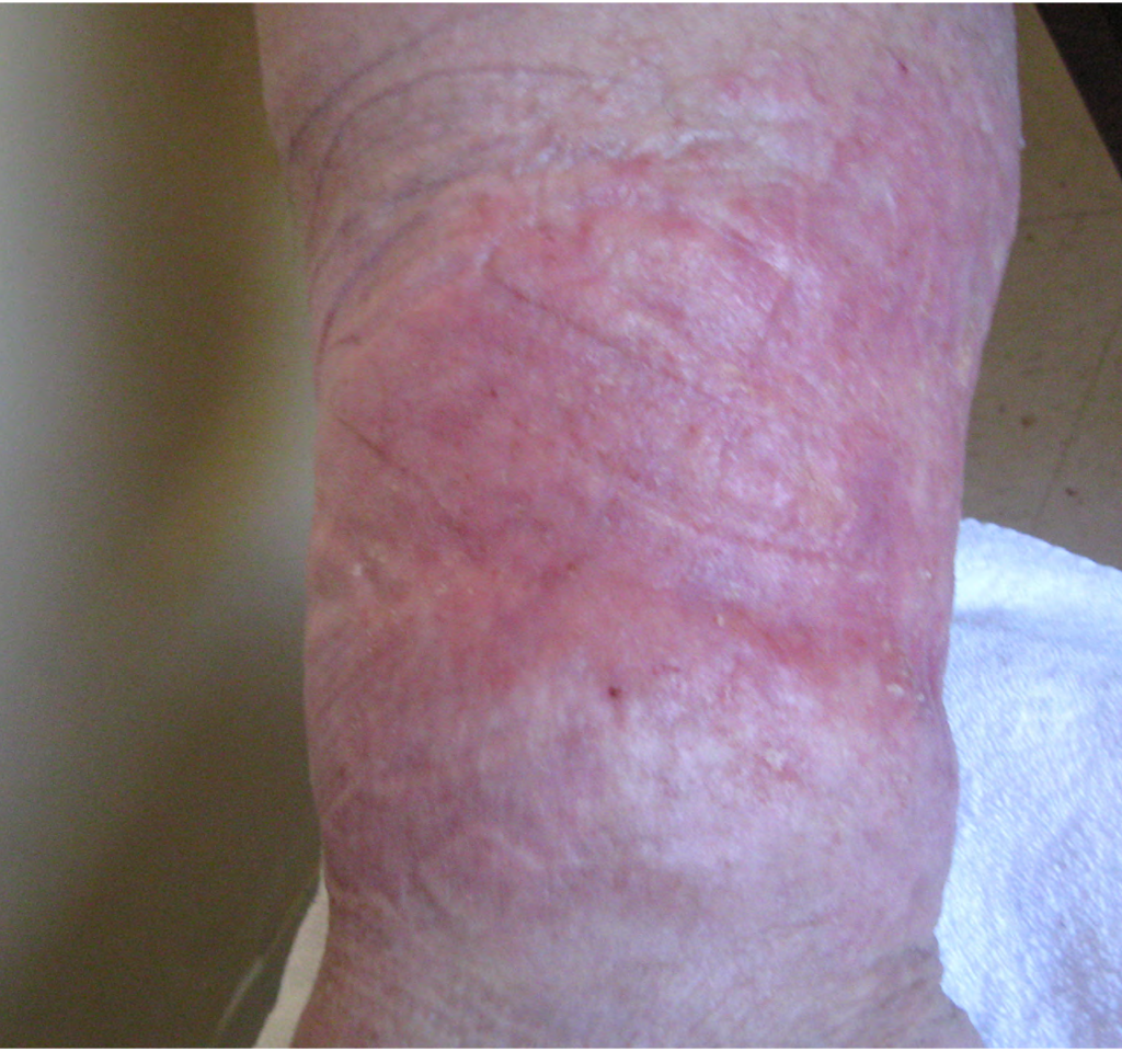 Ulcerated wound on leg healed after CWI treatments