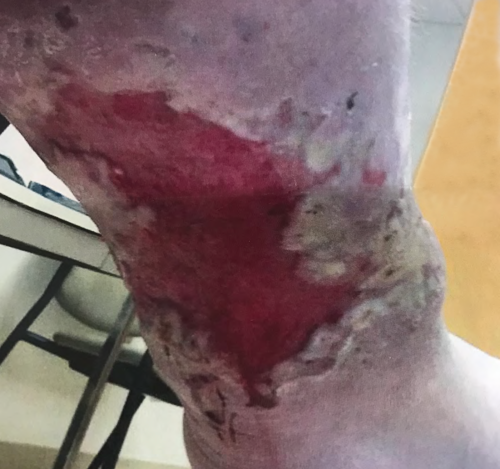 Ulcerated wound on leg before CWI treatments