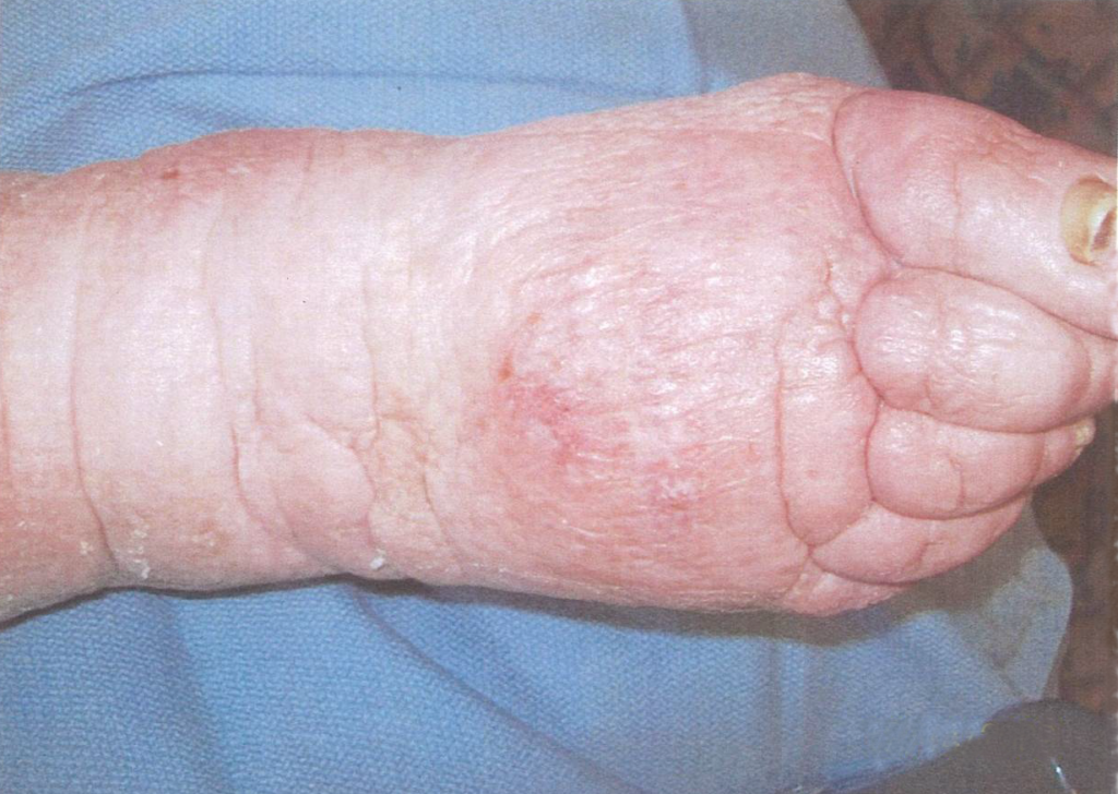 Ulcerated wound on foot after CWI treatments