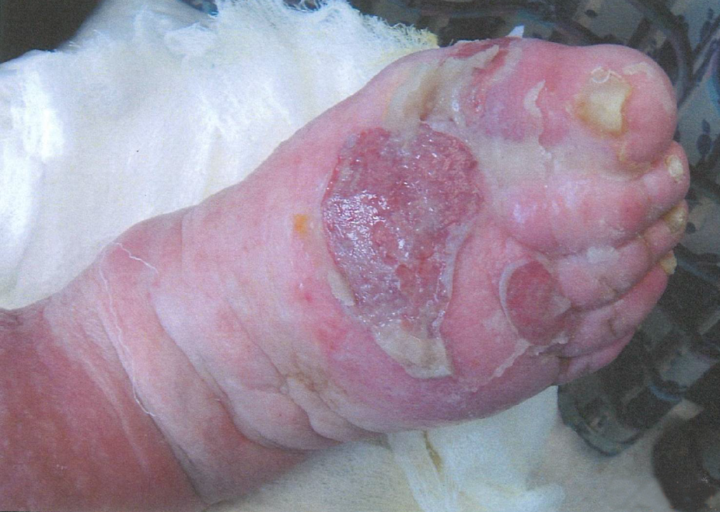 Ulcerated wound on foot before CWI treatments